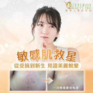 敏感肌救星 從受損到新生｜開啟肌膚的蝶變之旅
